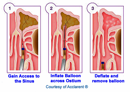 Balloon Sinuplasty Huntsville Ear Nose Throat