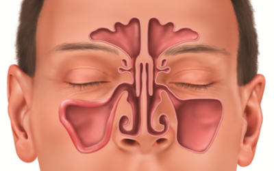 Chronic Sinusitis: An Overview of Sinus Surgery